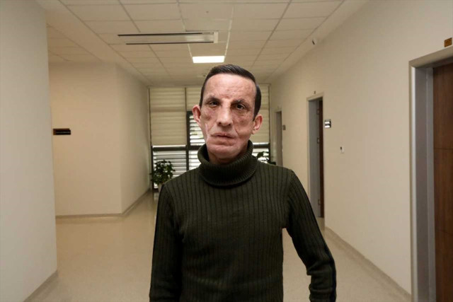 Türkiye'nin ilk yüz naklinin 14. yılı kutlandı - Resim: 1